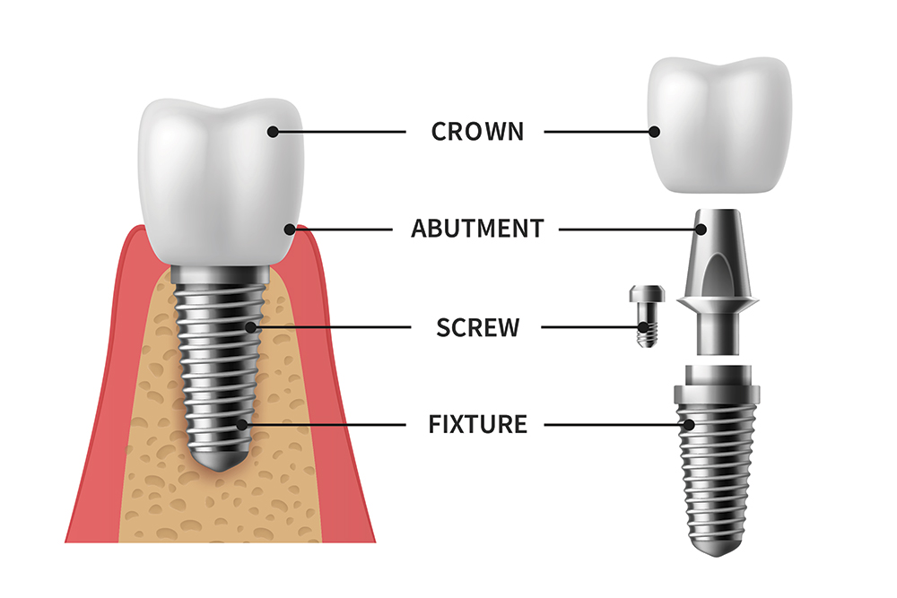 dentalimplants